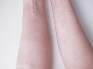 kosmetiikka allergia vai ärsytysreaktio